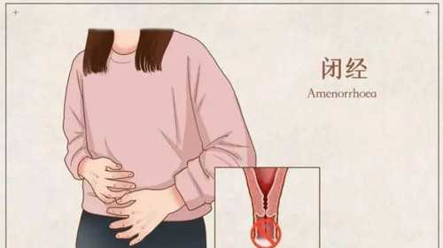 2026年输卵管不通必须做试管婴儿吗？深度解析不孕不育应对方案与辅助生殖策略