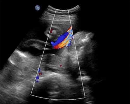 2026年深度解析：子宫纵膈对生育的危害及供卵助孕注意事项